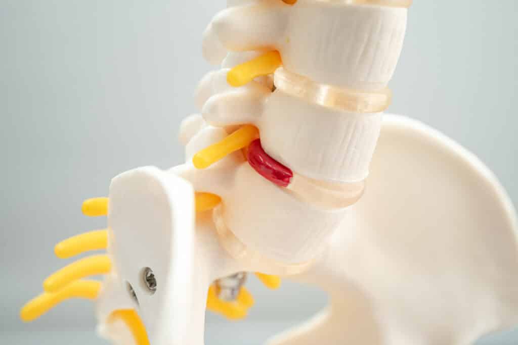 lumbar spine displaced herniated disc fragment, spinal nerve and degenerative disk disease
