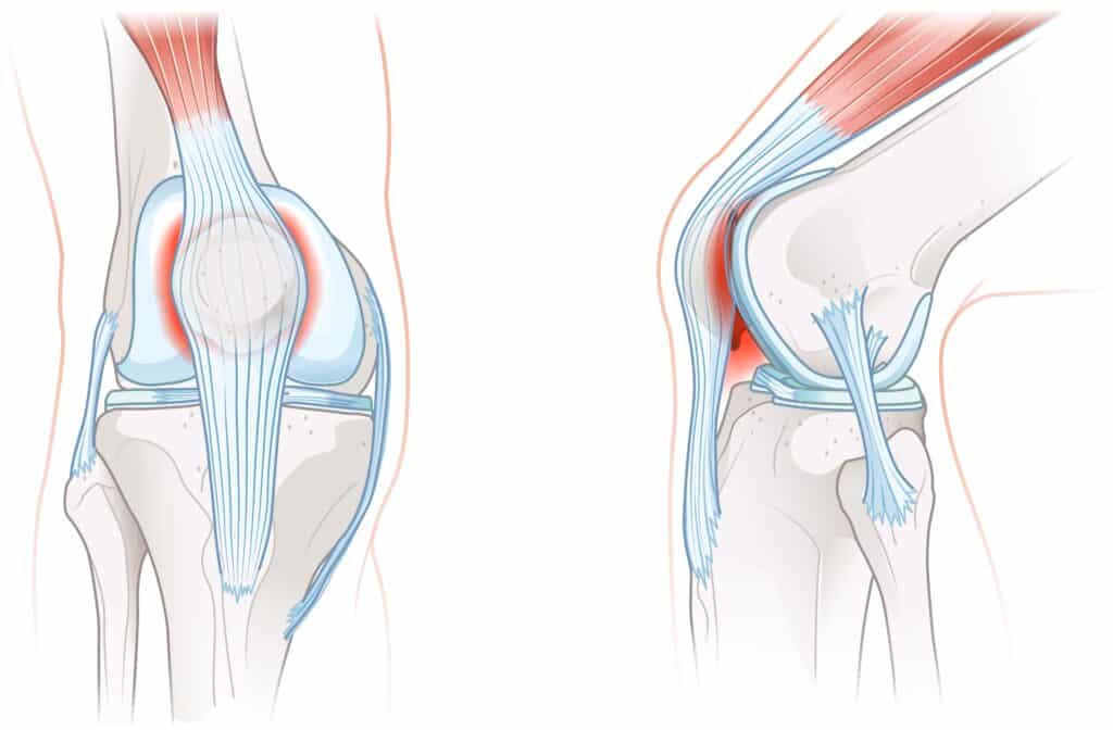 patellofemoral,pain,syndrome,involves,knee,discomfort,due,to,malalignment,,inflammation,