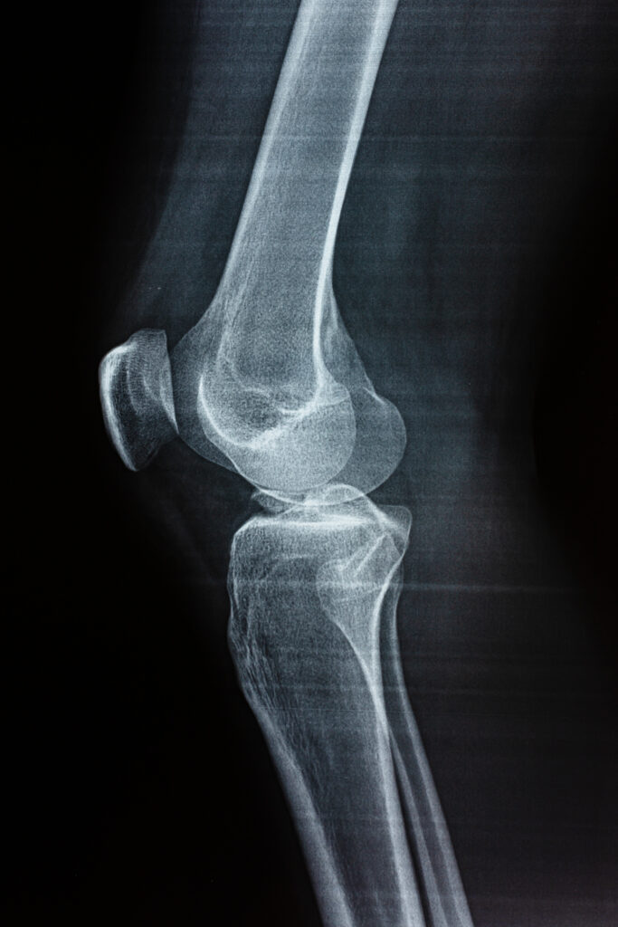 film x ray of a leg bone person