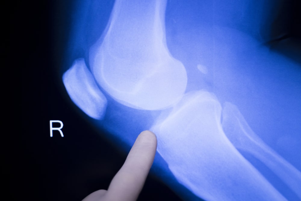 surgeon,indicating,with,hand,on,knee,and,meniscus,injury,medical