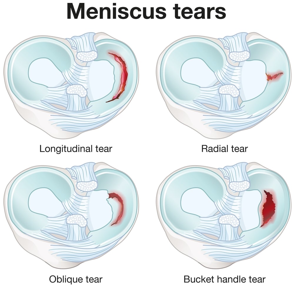 meniscus,tears,are,knee,injuries,causing,pain,,swelling,,and,limited