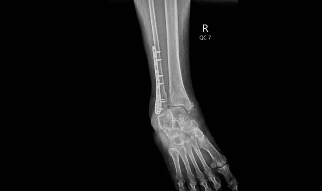 lateral,ankle,x ray,showing,distal,tibia,fracture,with,plate,and