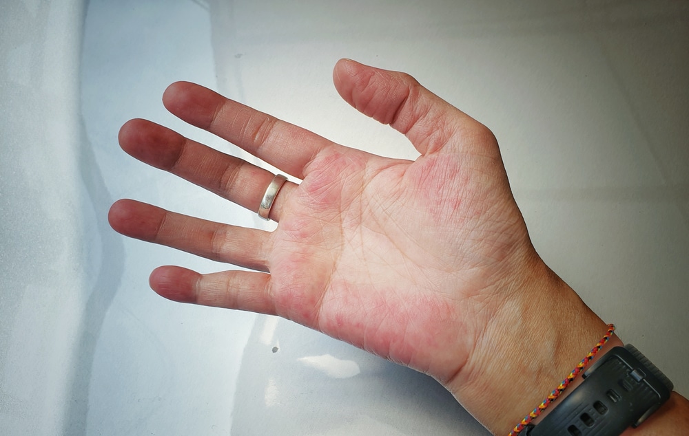 unusual,red,on,the,palm,hand,from,sle,symptom,effect