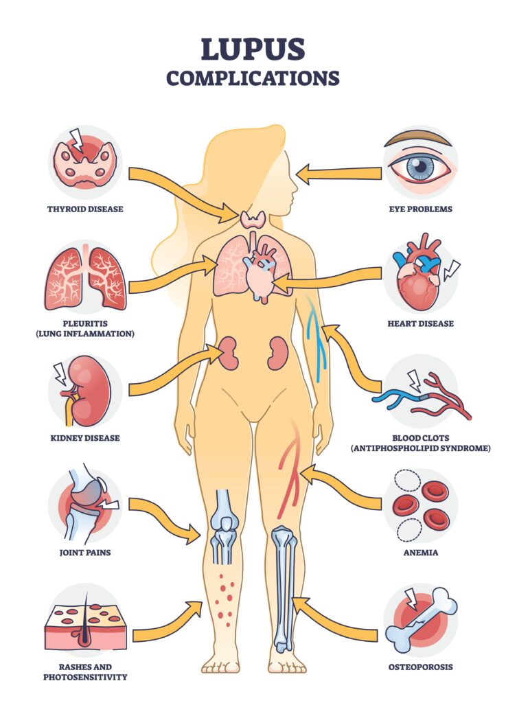lupus,erythematosus,medical,autoimmune,disease,complications,outline,diagram.,labeled,educational