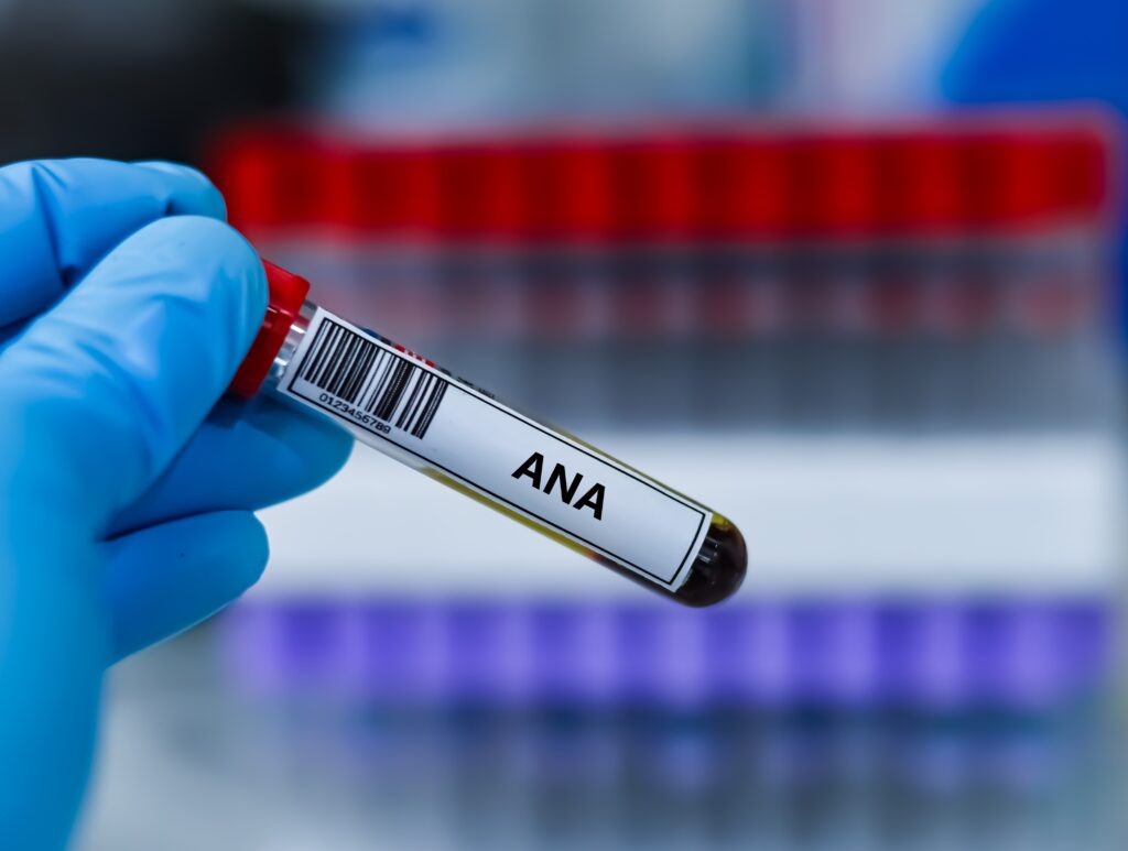 blood,sample,tube,for,anti nuclear,antibody,test,analysis.