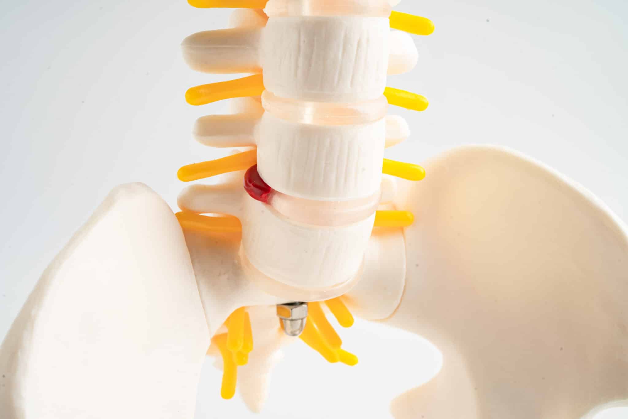 lumbar spine displaced herniated disc fragment, spinal nerve and