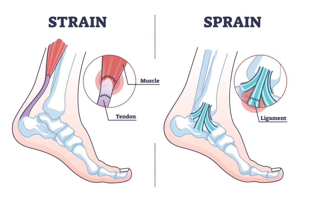 sprain,vs,strain,anatomical,comparison,as,medical,foot,injury,outline