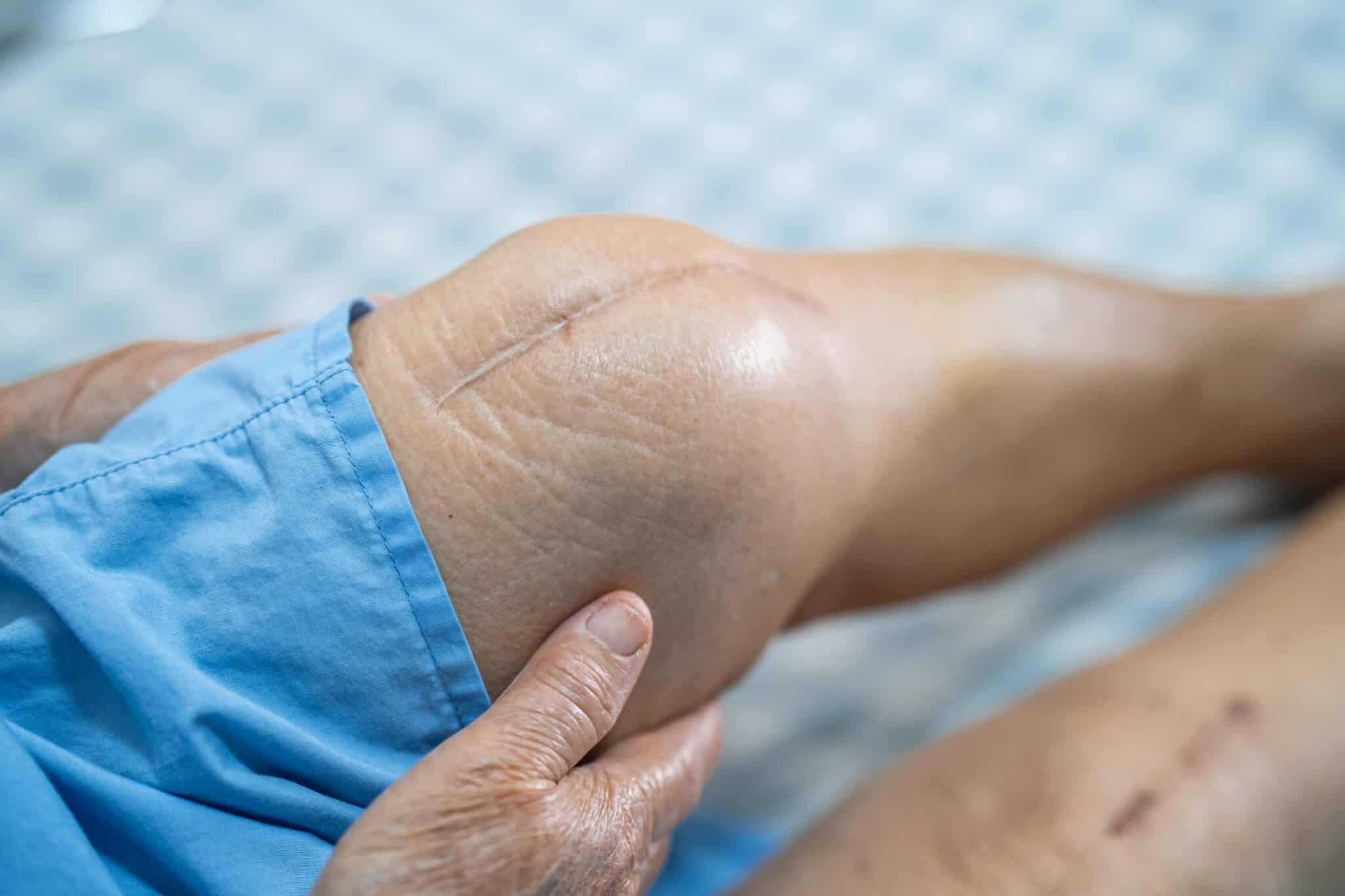 asian senior or elderly old lady woman patient show her scars su