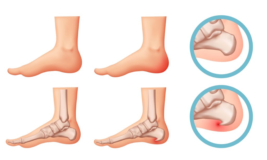 heel,spur,illustration.,design,elements,on,the,theme,of,plantar