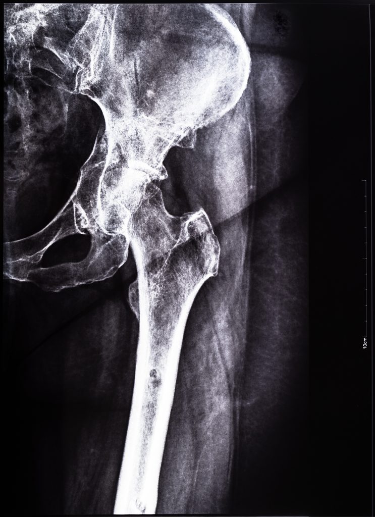 negative x ray of junction of tibia and pelvis